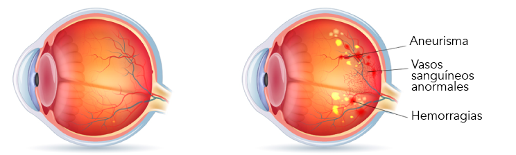 ojo normal retinopatia diabética