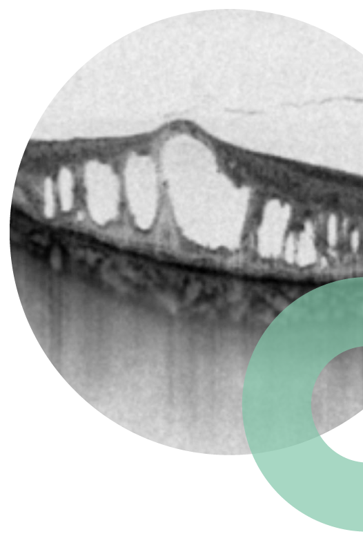 Edema macular diabetico