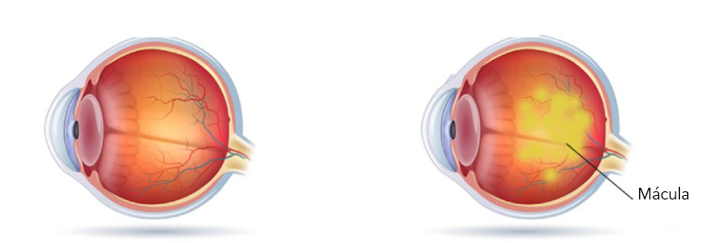 Degeneracion Macular